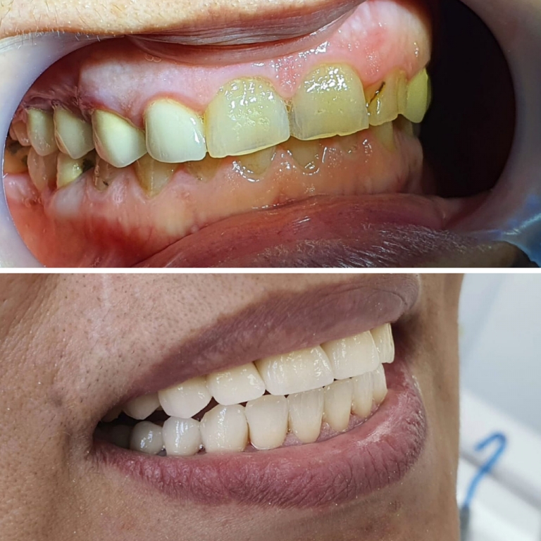 Pret Implant Dentar In Bucuresti Recomandarile Medicilor In 2023