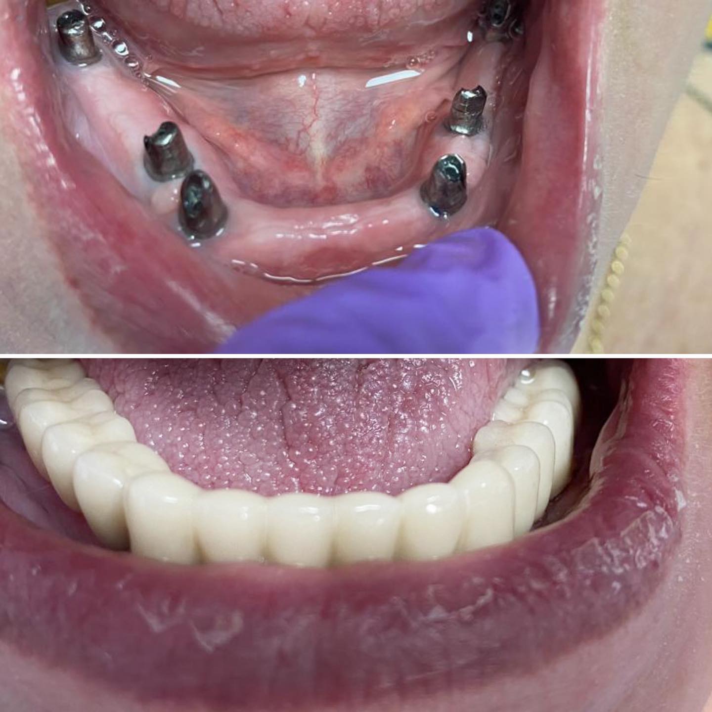 Pret Implant Dentar In Bucuresti Recomandarile Medicilor In